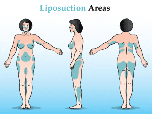 Find out if you are a good candidate for liposuction Areas for Liposuction