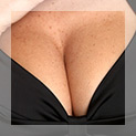 Breast reduction
