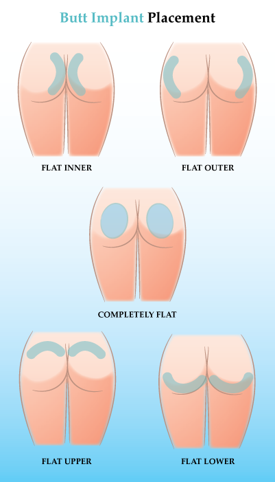 Girl Sitting By Herself Cost Of Butt Augmentation