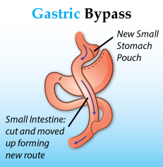 What is the recovery time for gastric surgery?