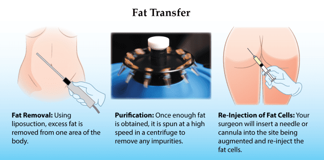 Cost Of Fat Transfer 58