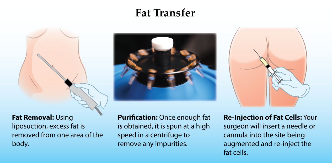 Fat Transfer To The Butt 51