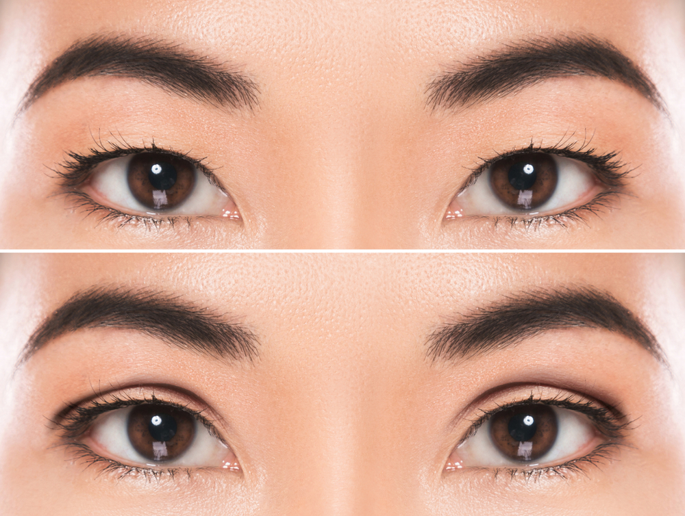 Asian Eyelid Surgery Before and After Photo