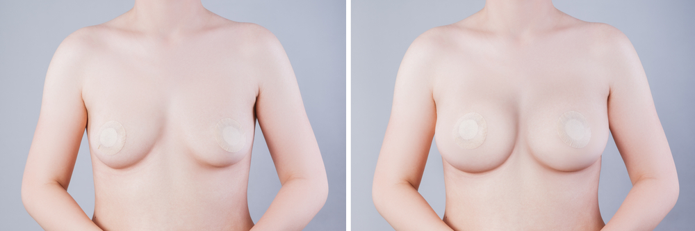 Cost of Breast Augmentation - A Closer Look at Pricing Factors