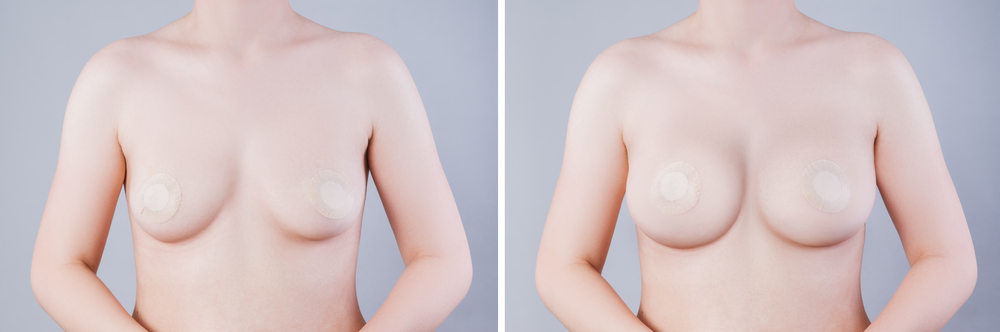 Breast Augmentation Before and After Photo