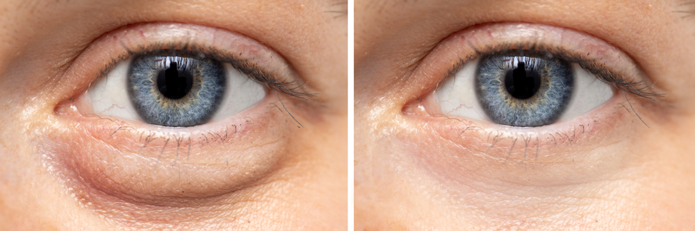 Eyelid Surgery Before & After Photo