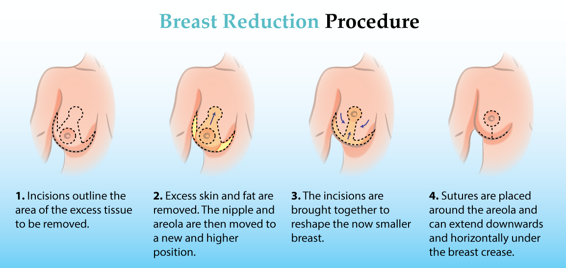 Breast Reduction Procedure Incisions