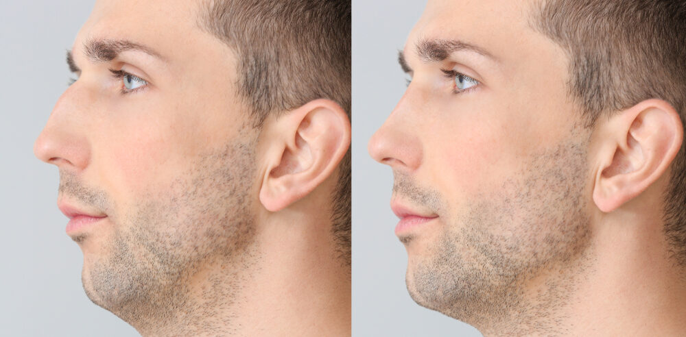 Rhinoplasty Before and After Photo