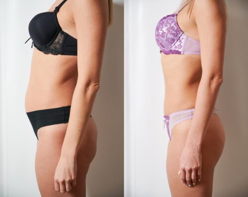 Tummy Tuck Before and After Photo
