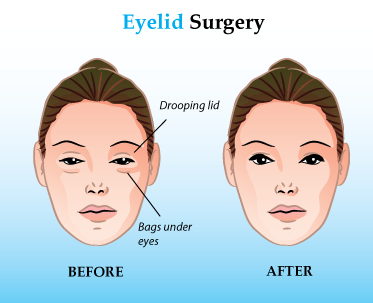 Eyelid Surgery Upper Lower Cost Recovery Time Etc
