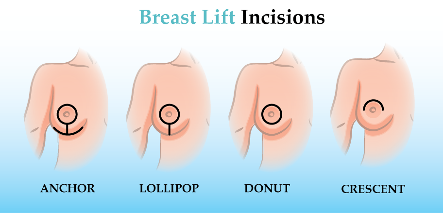 Breast Lift Incisions