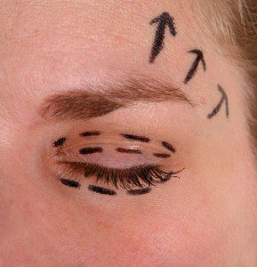 About Eyelid Surgery