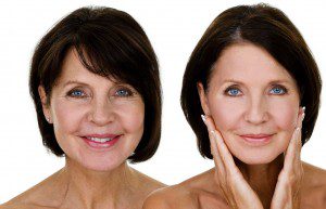 Facelift Surgery