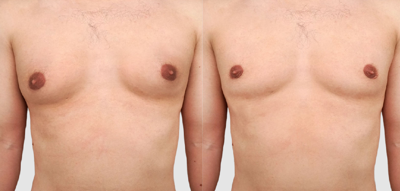 Gynecomastia Surgery Before & After Photo