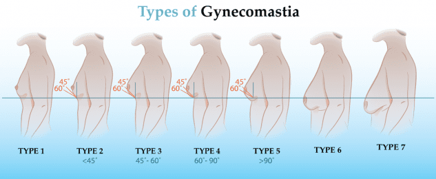 Types of Gynecomastia