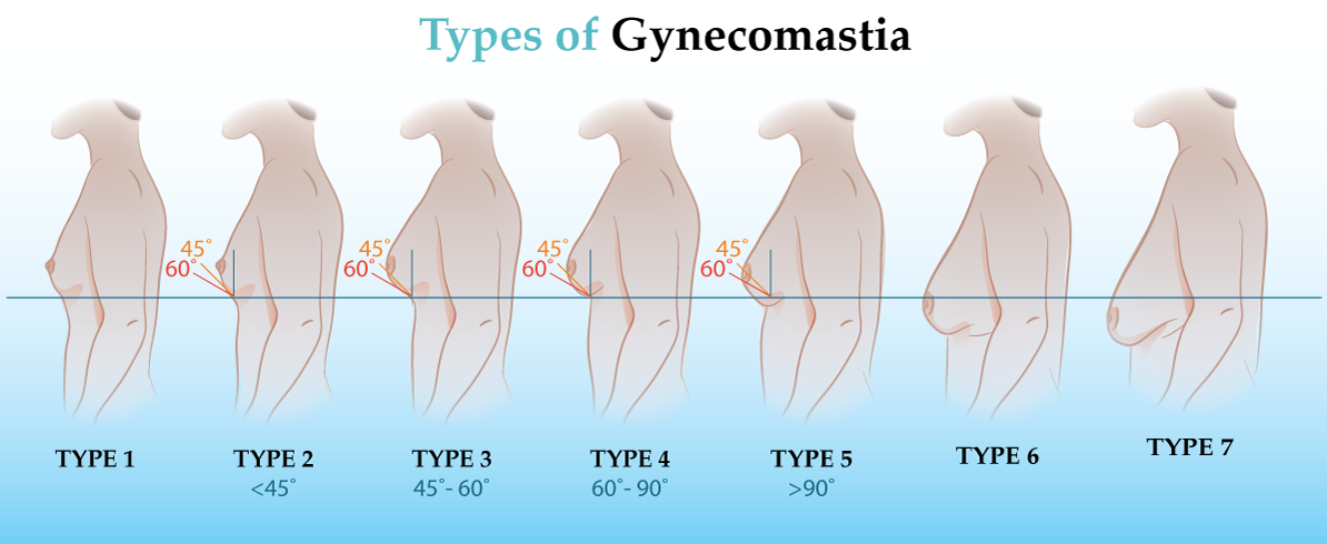 A Male Breast Reduction (Gynecomastia) Procedure - Gynecomastia Surgery Cost  India