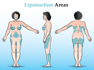 Liposuction Treatment Areas