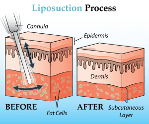 Liposuction Procedure