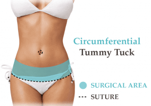 Circumferential Tummy Tuck