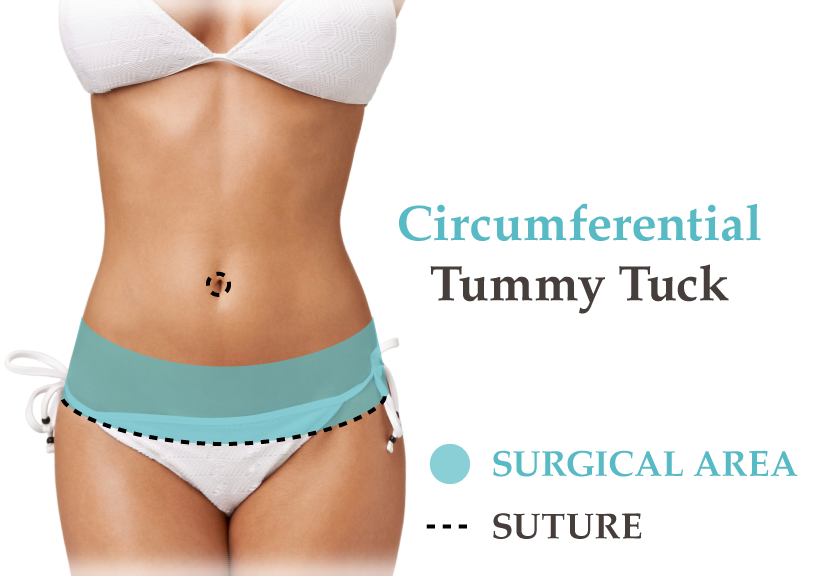 Circumferential Tummy Tuck.