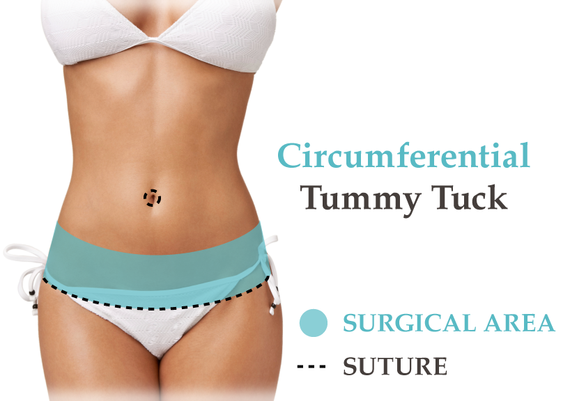 Cost of Tummy Tuck - Surgery, Benefits, Results, etc.