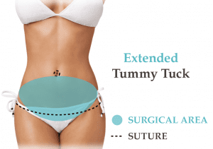 Extended Tummy Tuck Surgery