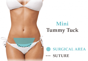 Mini Tummy Tuck Surgery