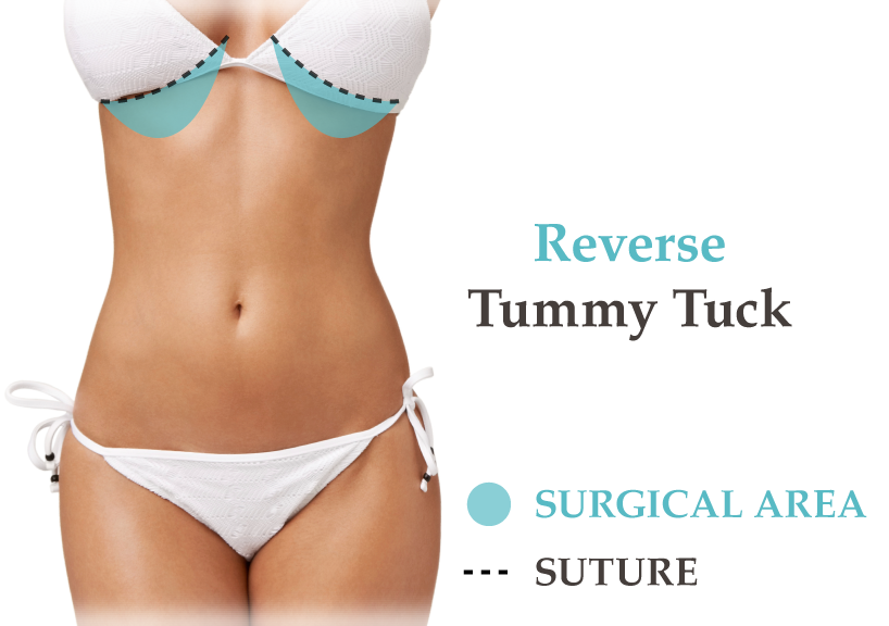 Upper Abdominoplasty - Reverse tummy tuck 