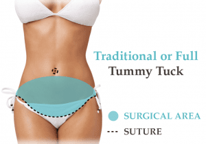 Traditional or Full Tummy Tuck