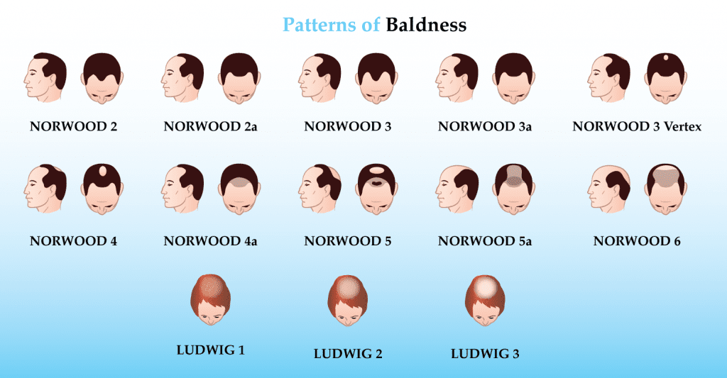 Patterns of Baldness (Hair Loss)