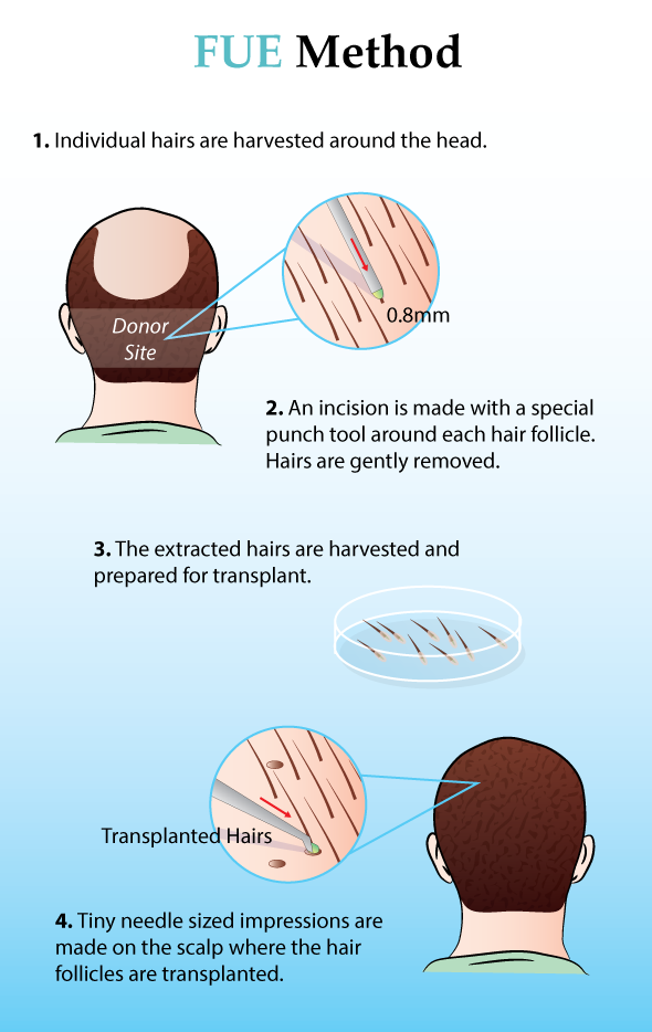 FUE Hair Transplant Procedure
