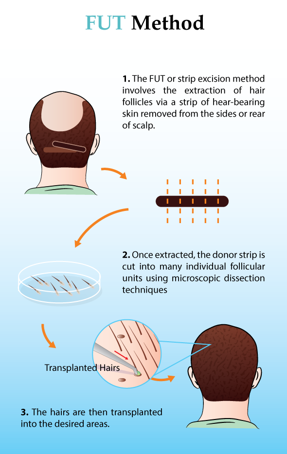 FUT Hair Transplant Procedure