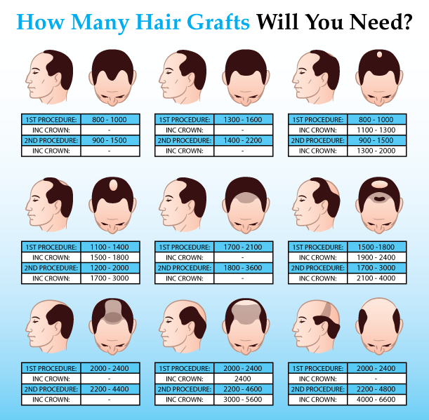 How many hair grafts will you need?