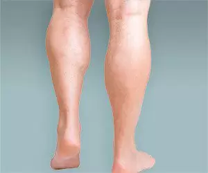 Calf implants