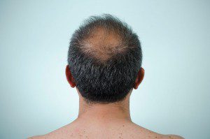 Hair Transplant Surgery