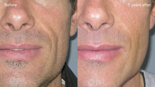 Bellafill Before & After Photo
