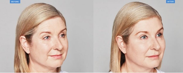 Restylane Before & Afterss
