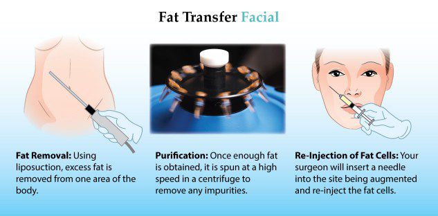 Fat Transfer Facial