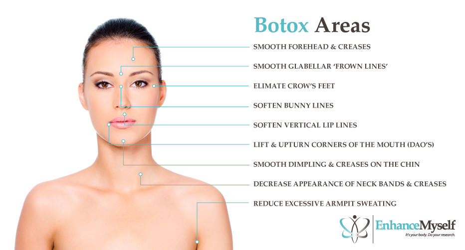 Botox® Areas