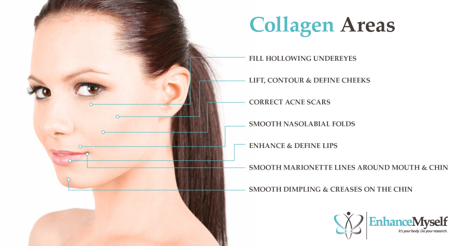 Collagen injection areas