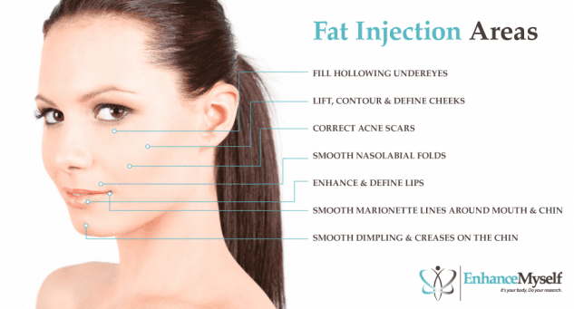 Fat injection areas