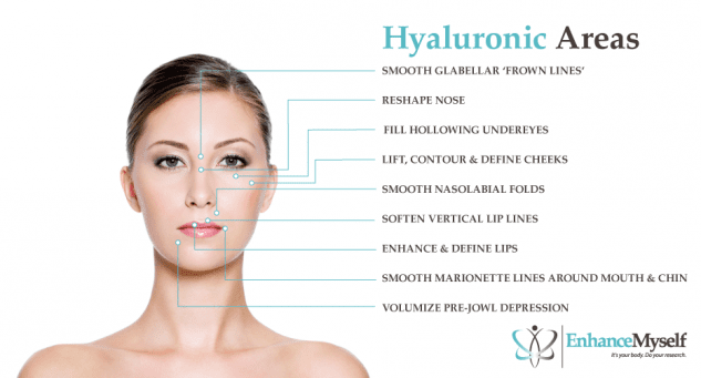 Hyaluronic acid filler treatment areas