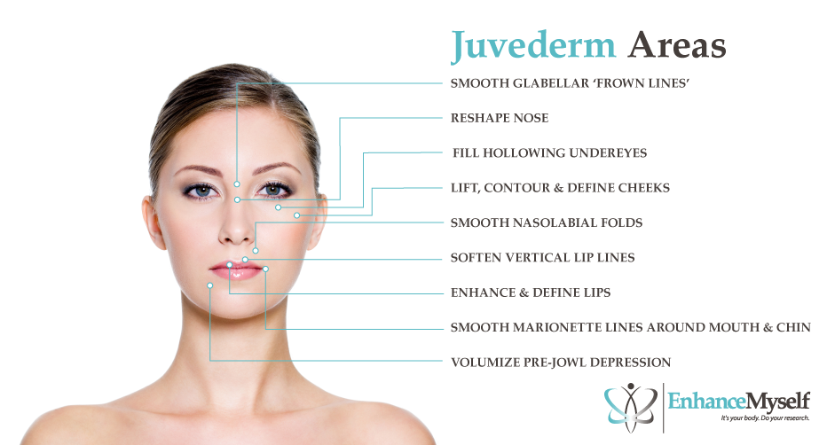 Juvederm® Treatment Areas