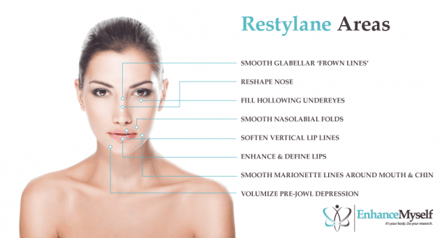 Restylane Treatment Areas