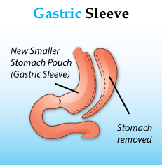 Gastric Sleeve Procedure