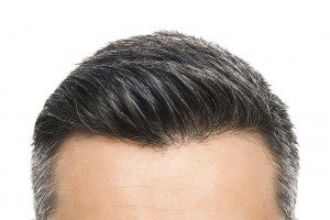 Hairline Lowering (Forehead Reduction)