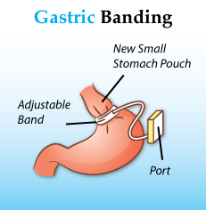 Lap Band Procedure