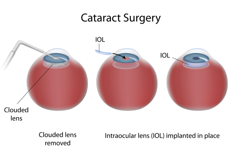 Cataract Surgery IOL
