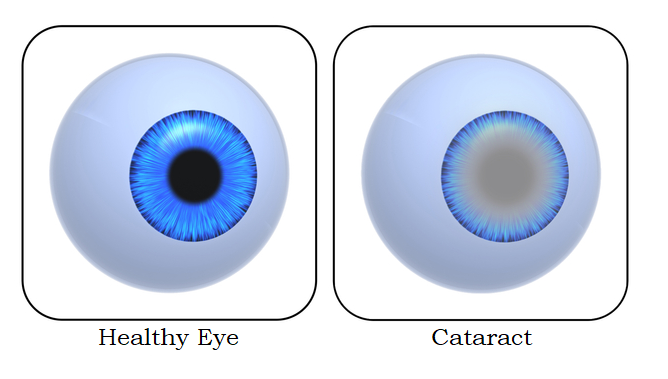 Healthy Eye vs Cataract