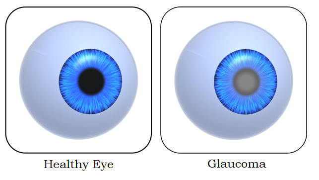 Healthy Eye vs. Glaucoma